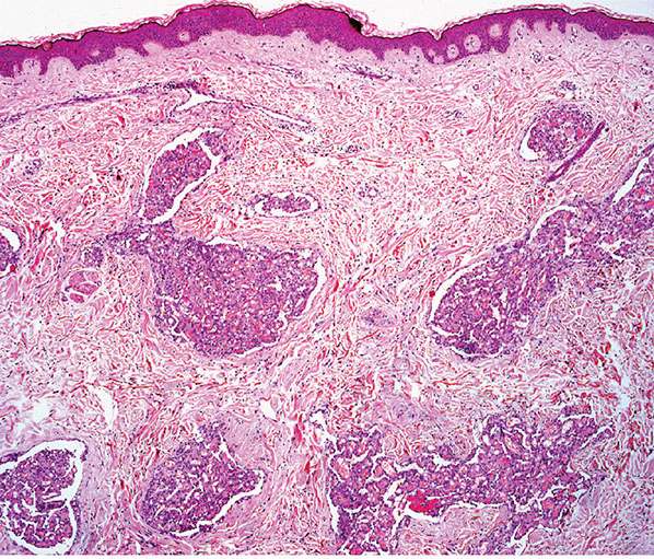 Vascular Tumors Tumors And Tumorlike Conditions Of Blood Vessels And Lymphatics Plastic Surgery Key