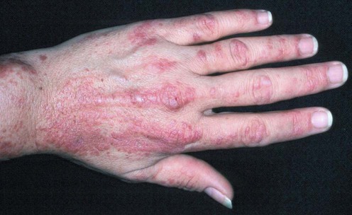 Image result for dermatomyositis images