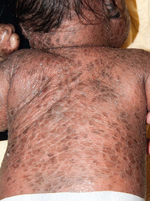 severe ichthyosis vulgaris