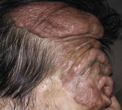 neurofibromatosis type i