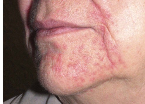 perioral dermatitis chin