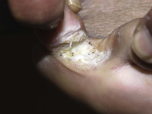 Tinea pedis and skin dermatophytosis