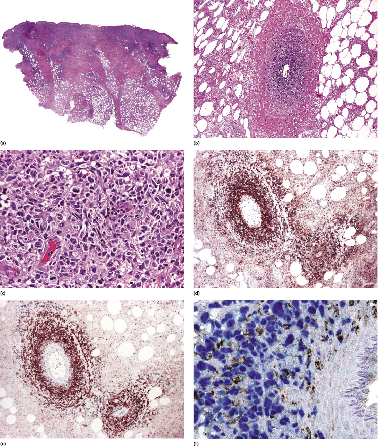 15: Other Cutaneous B-Cell Lymphomas | Plastic Surgery Key