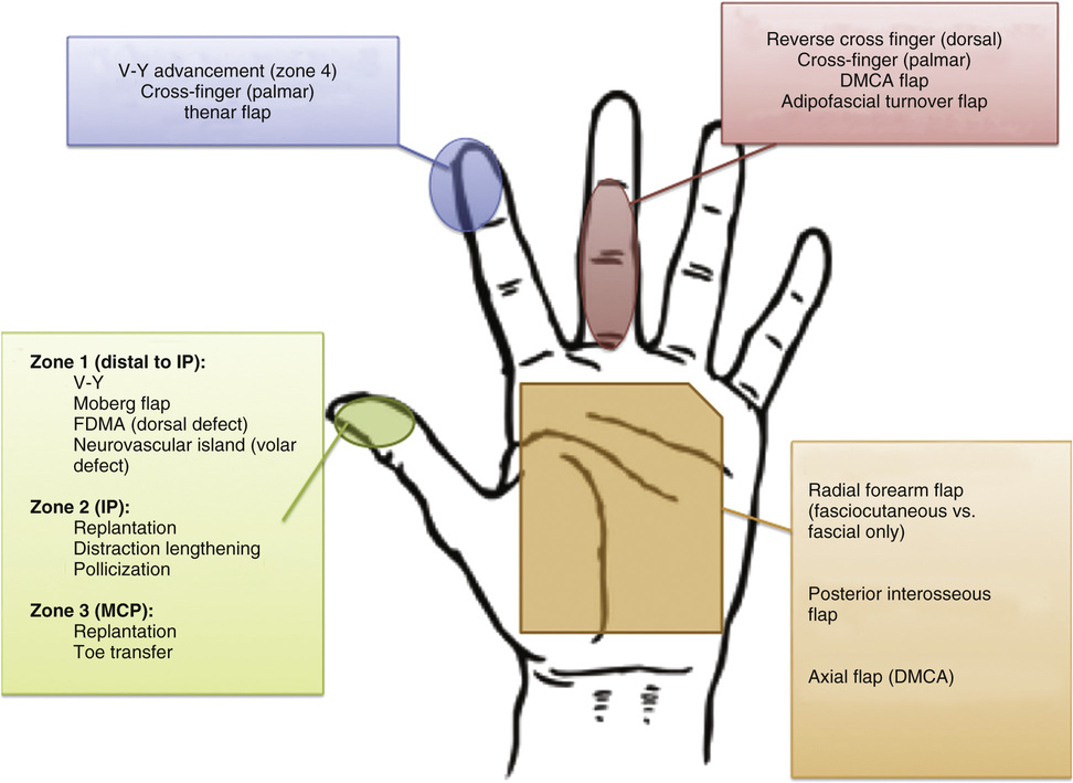 Nail-Bed Injuries, Soft-Tissue Amputations, and Replantation | Plastic ...