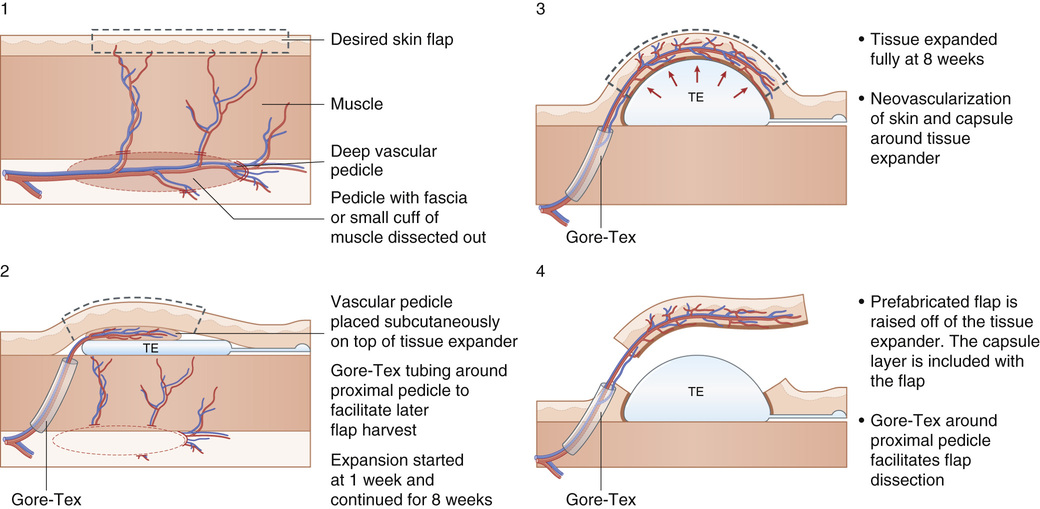 flaps-and-microsurgery-plastic-surgery-key