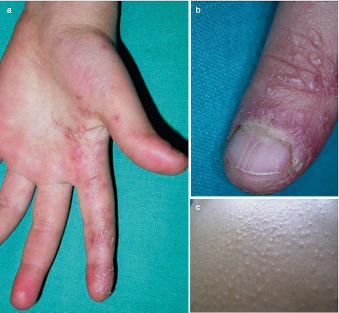 Lichen Striatus With Nail Dystrophy