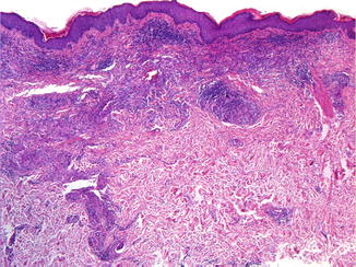 lung metastases cutaneous cancer fig