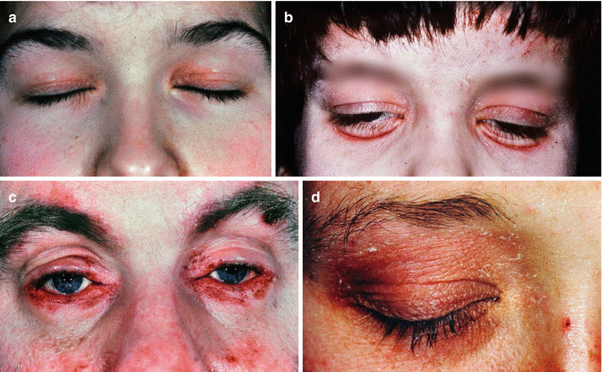 Heliotrope Rash Eyelid