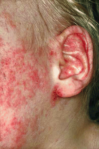 aural eczematoid dermatitis