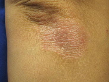 psoriasis plastic surgery)