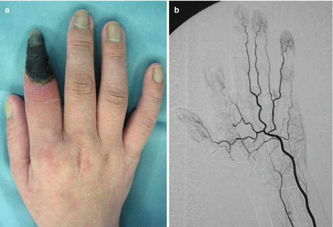 Rheumatoid And Systemic Collagenosis Vasculitis Plastic Surgery Key