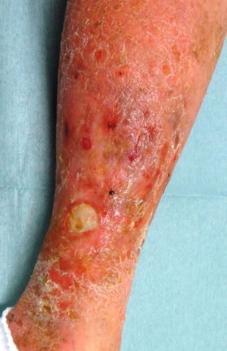 Rheumatoid And Systemic Collagenosis Vasculitis Plastic Surgery Key