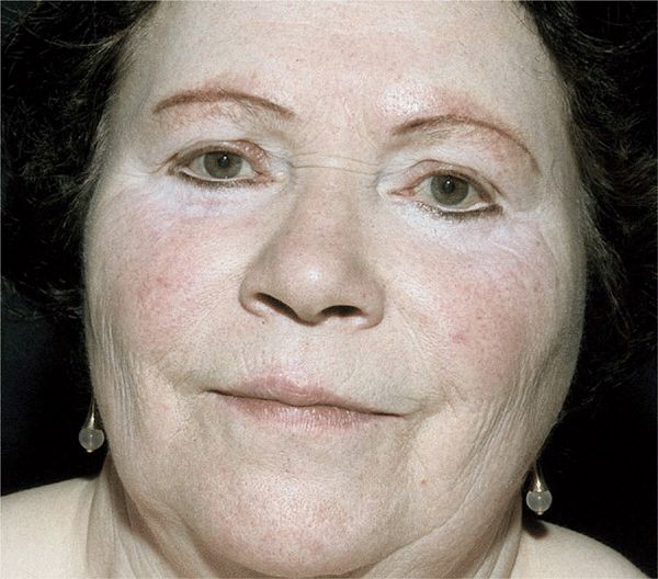 vitiligo universalis