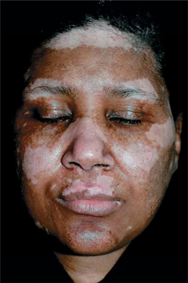 melanotic macule icd 10 Moles (melanocytic naevi, pigmented nevi) main image 1