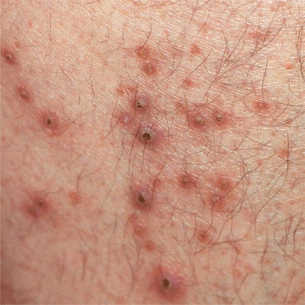 Uremic Rashes What Is Uremic Frost