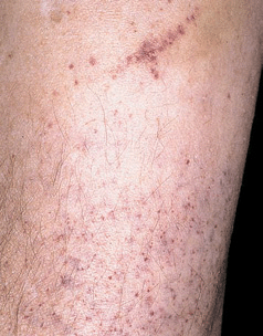 platelet disorders pinpoint rash