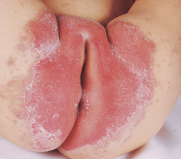 Nipple eczema images