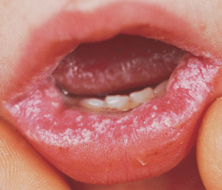 yeast on lips