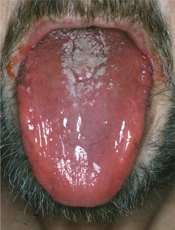 atrophic candidiasis