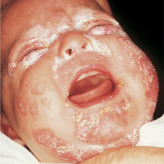 mucocutaneous candidiasis