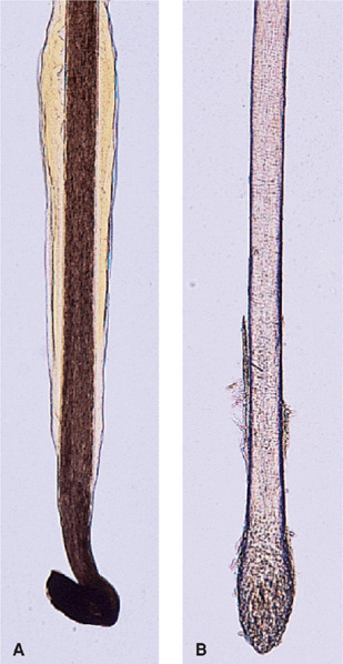 Trichorrhexis Nodosa  A Hair Shaft Disorder  Hair Transplant Toronto   Voted best hair restoration Toronto