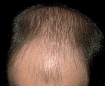 What are Different Types of Hair Diseases with pictures