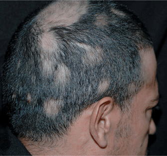 Common Hair Problems  Skinsight