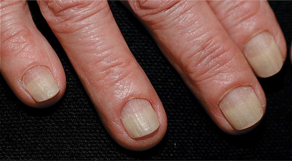 Hands on a White Background with Nail Lesions-onycholysis. Separation of  the Nail Plate from the Nail Bed after Manicure Stock Image - Image of  medicine, medical: 260713203