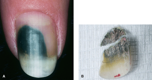 Nail Trauma - Harvard Health