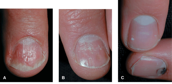 Surgical approach to retronychia refractory to clinical treatments