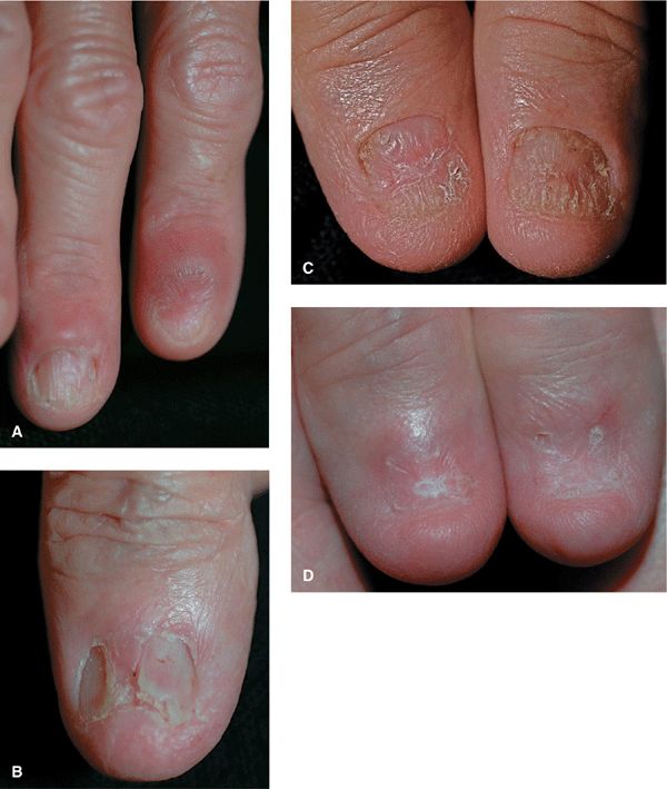 Subungual Chronic Radiodermatitis