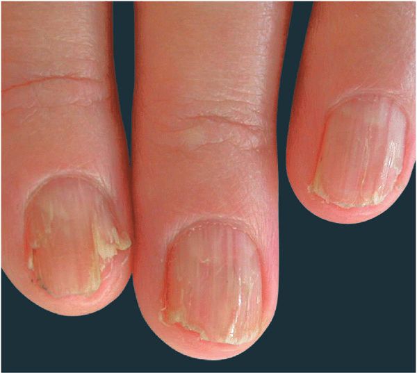 4-70 Darier's disease of the nails
