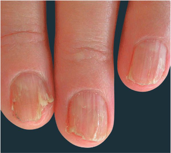 Symmetrical erythematous papules and plaques on the dorsum of the hands...  | Download Scientific Diagram