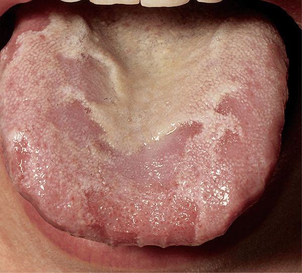tongue papilloma icd 10 human papillomavirus vaccine 16