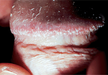 prominent sebaceous glands anus