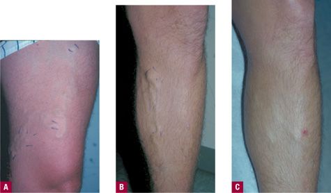 Treatments for varicose veins (IV): classic surgery / stripping