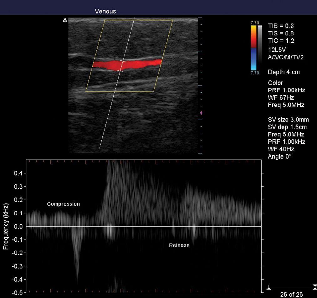 venous duplex