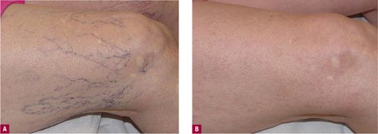 Sclerotherapy Of Small Veins Plastic Surgery Key