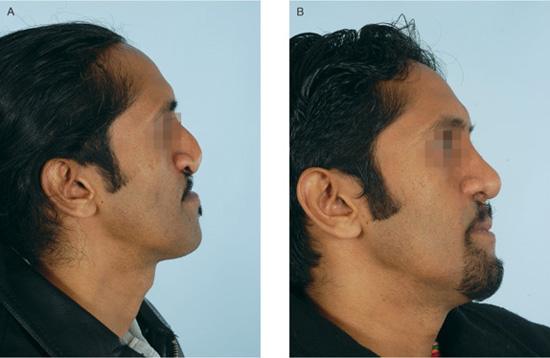 lengthening-the-short-nose-plastic-surgery-key