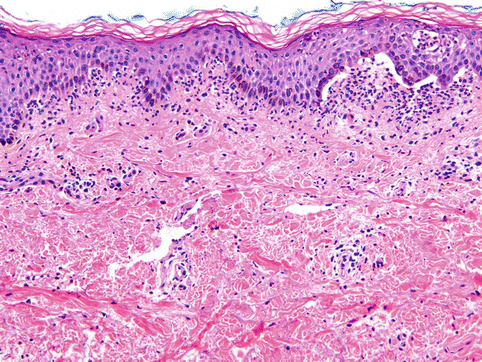 Clinical Features And Pathogenesis Of Chronic Bullous Disease Of ...