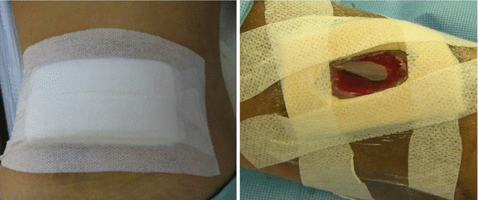 Interactive Wound Dressings | Plastic Surgery Key