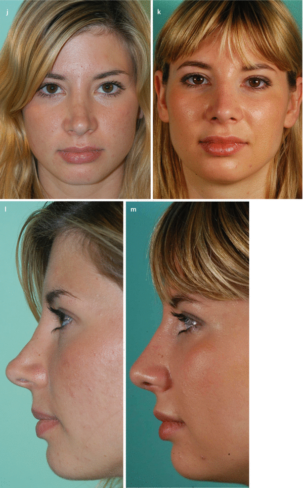 Functional Aspects In Secondary Rhinoplasty | Plastic Surgery Key