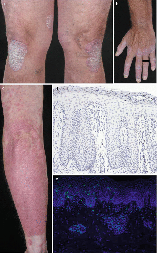 Immunopathogenesis Of Psoriasis | Plastic Surgery Key