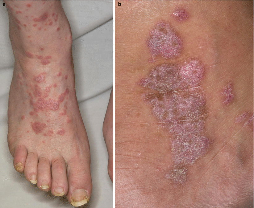 Lichen Planus Skin Rash