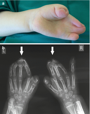 Syndactyly | Plastic Surgery Key