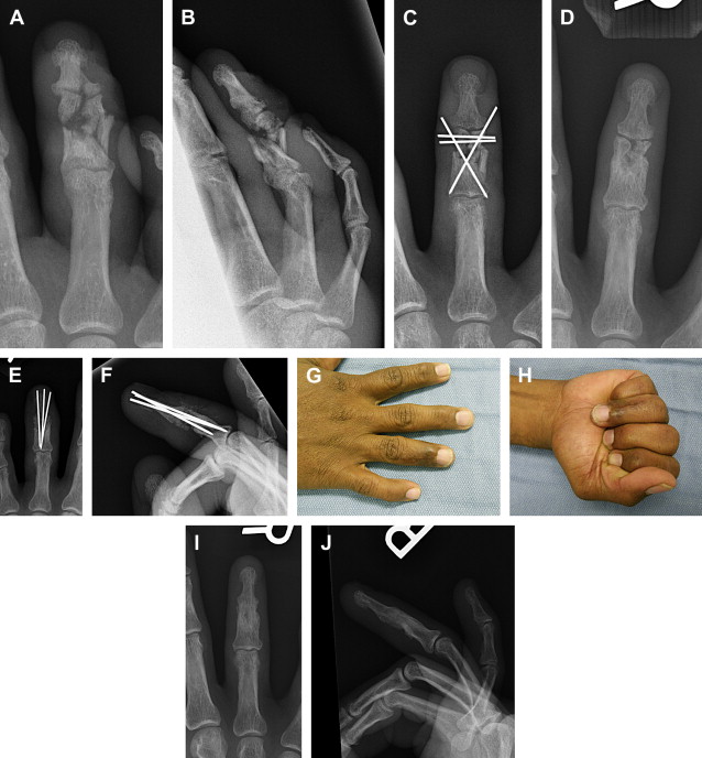 Treatment Of Nonunion And Malunion Following Hand Fractures | Plastic ...