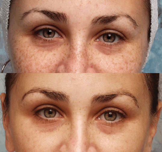 Chemical And Laser Skin Resurfacing | Plastic Surgery Key