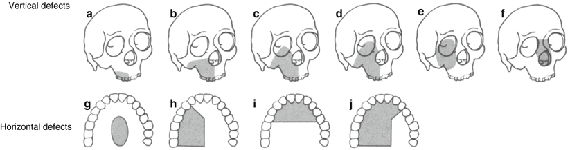 Repair And Reconstruction Of Maxillary Defects | Plastic Surgery Key