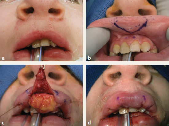Cleft Lip and Cleft Palate
