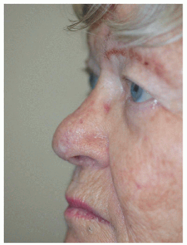 Nose Reconstruction - Plastic Surgery KeyPlastic Surgery Key